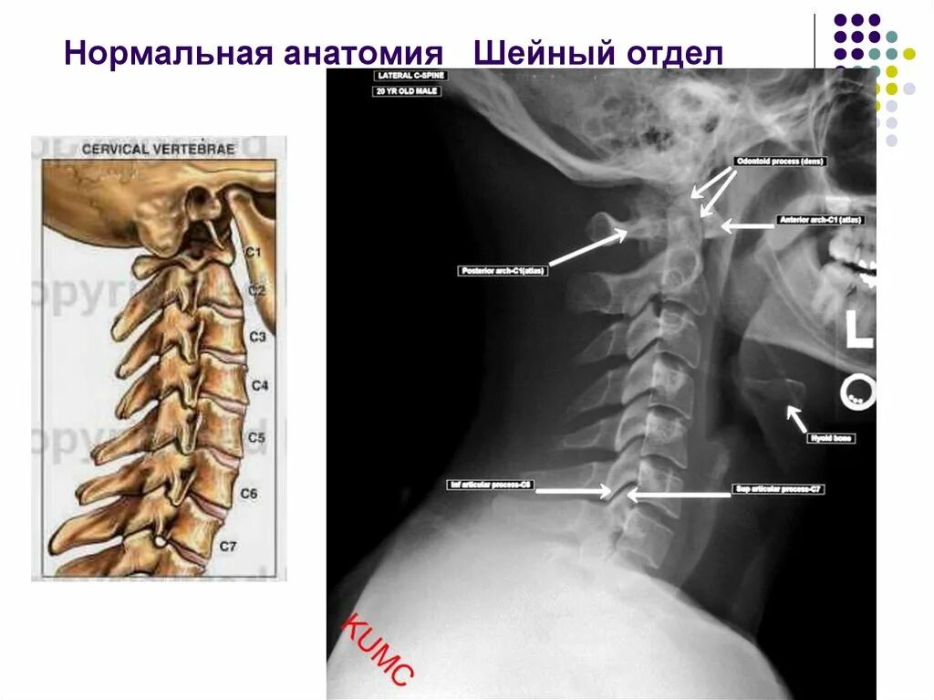 Позвонки шейного отдела позвоночника фото В шейном отделе позвоночника всегда 5 позвонков