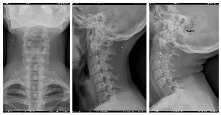 Позвонки шейного отдела позвоночника фото Нестабильность шейного отдела позвоночника: симптомы и лечение - Medside.ru