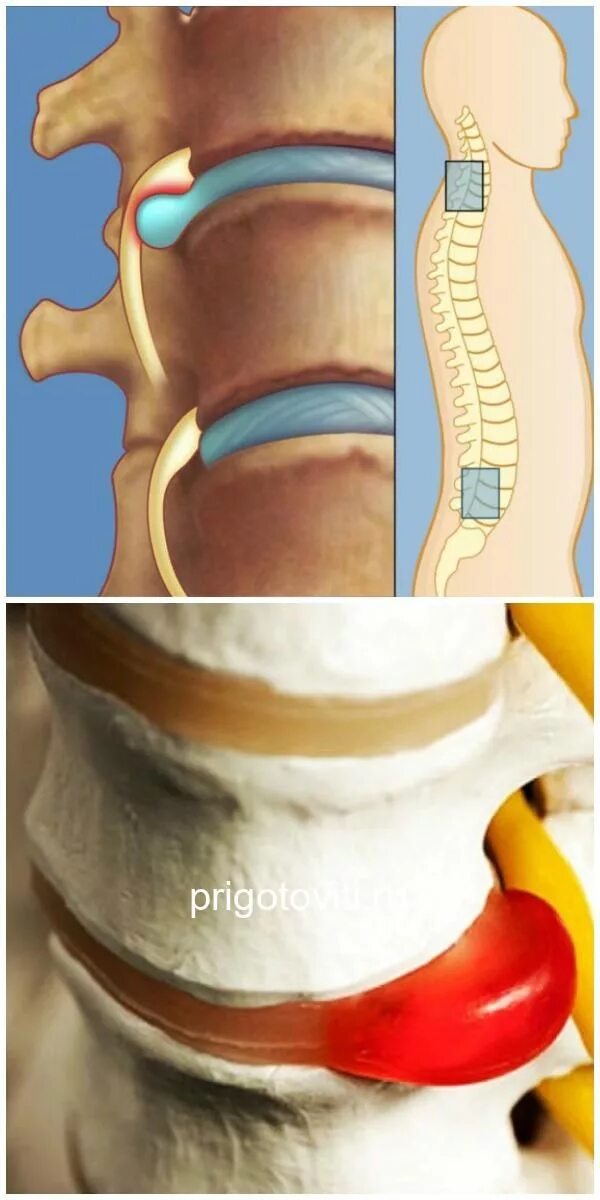 Позвоночная грыжа поясничного отдела симптомы фото Картинки МЕЖПОЗВОНКОВАЯ ГРЫЖА ПОЯСНИЧНОГО ОТДЕЛА СИМПТОМЫ