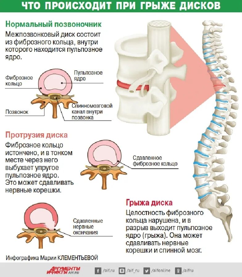 Позвоночная грыжа поясничного отдела симптомы фото Лечение межпозвоночной грыжи - Медцентр "Диагност" - Благовещенск