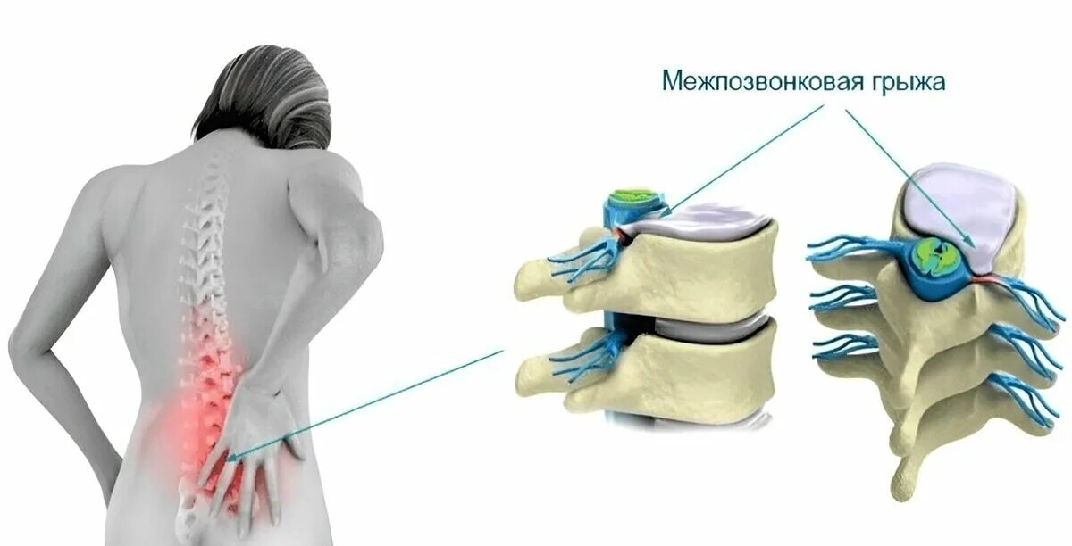 Позвоночная грыжа симптомы фото Почему болит поясница? Продолжение Доктор Котляр Владислав Альбертович Дзен