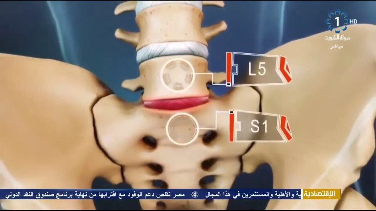 Позвоночная грыжа симптомы фото أهم مشاكل العمود الفقري والديسك وطرق العلاج ج1 - YouTube