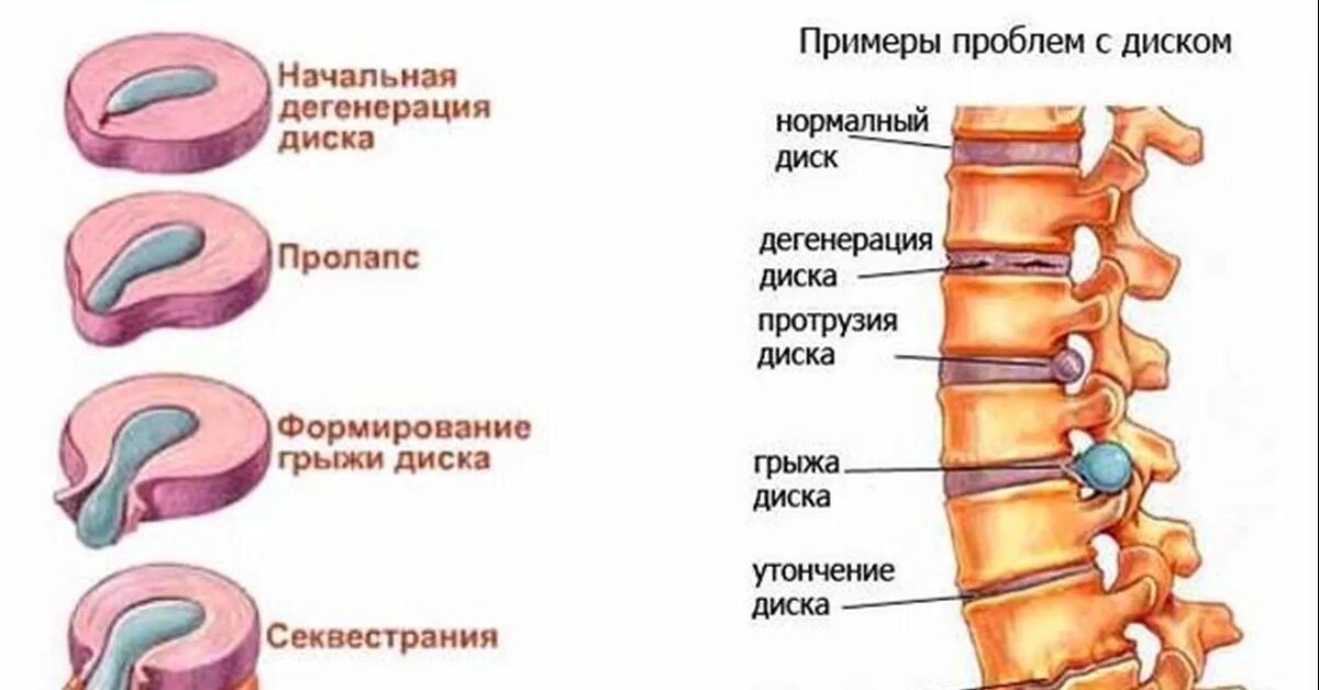 Позвоночная грыжа симптомы фото Резорбция грыжи межпозвонкового диска. Реальный пример и теория Пикабу
