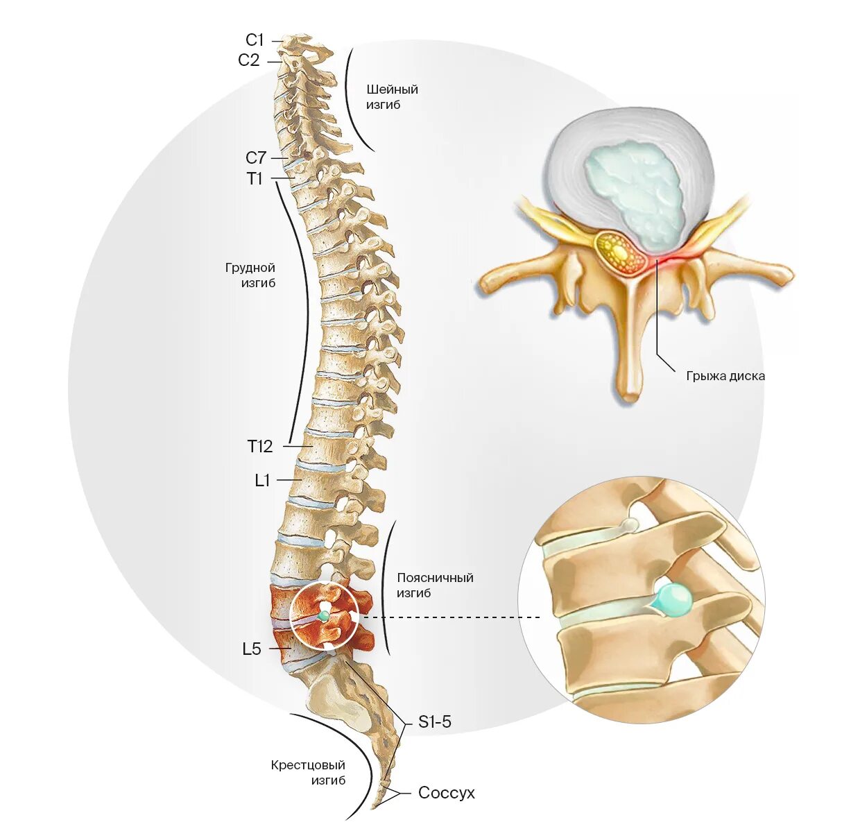 Позвоночные грыжи поясничного отдела фото Грыжа межпозвоночного диска L5 S1 - симптомы, лечение без операции Клиника Ткаче