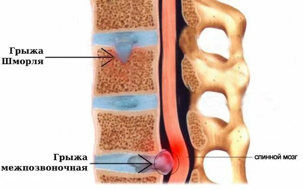 Позвоночные грыжи поясничного отдела фото Грыжа Шморля: причины, симптомы и лечение в статье невролога Котляр Я. А.