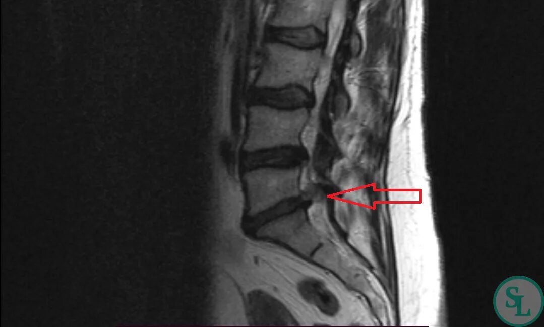 Позвоночные грыжи поясничного отдела фото Поясничная грыжа примеры работ и операций SL Клиника - лечение заболеваний позво