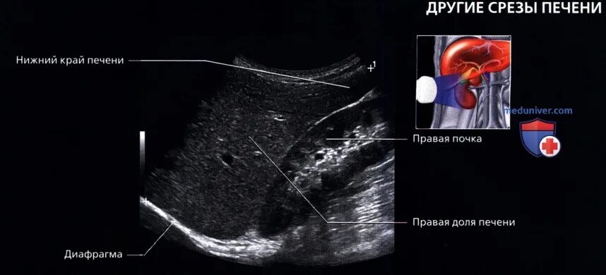 Правая доля печени фото УЗИ анатомия печени в норме