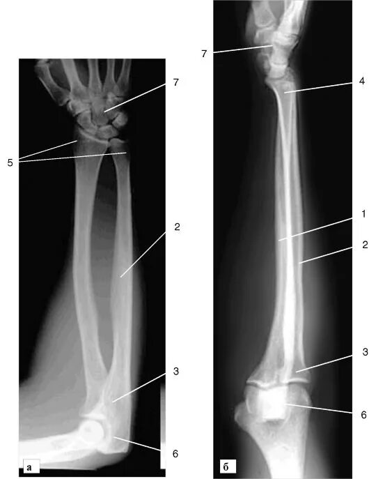 Правая лучевая кость фото ГЛАВА 3 КОСТНО-СУСТАВНАЯ СИСТЕМА