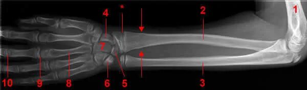 Правая лучевая кость фото Forearm X-ray - W-Radiology