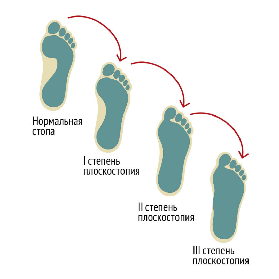 Правильная стопа человека как выглядит фото Тест на плоскостопие КИТ Клиника Ильи Труханова в Куркино Дзен