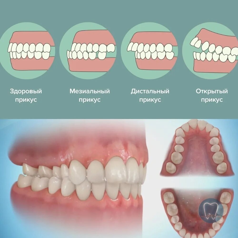 Правильное расположение зубов фото Неправильный прикус у ребенка: как определить