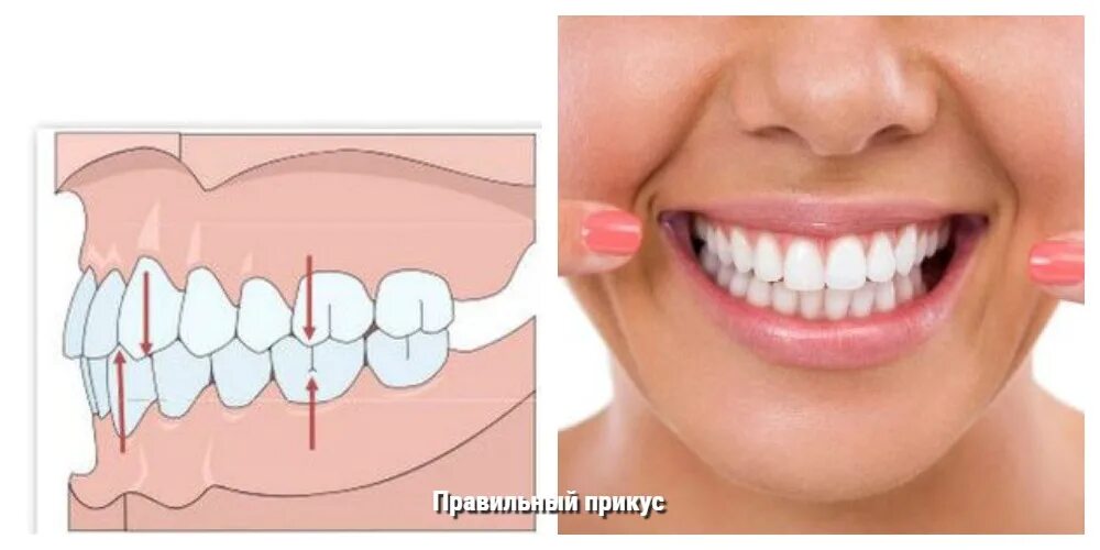 Правильное смыкание зубов фото Неправильный прикус у взрослого и ребенка: какой бывает и почему это проблема