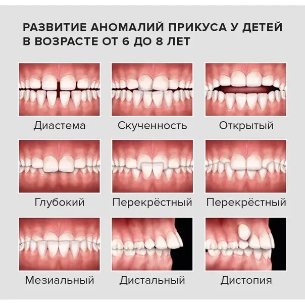 Правильное смыкание зубов фото Неправильный прикус у ребенка (Виды, причины, лечение)