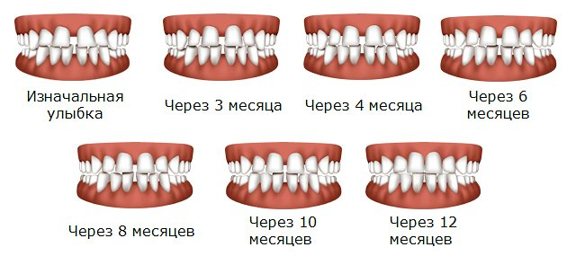 Правильное смыкание зубов фото Доступное решение по производству прозрачных элайнеров в своей клинике