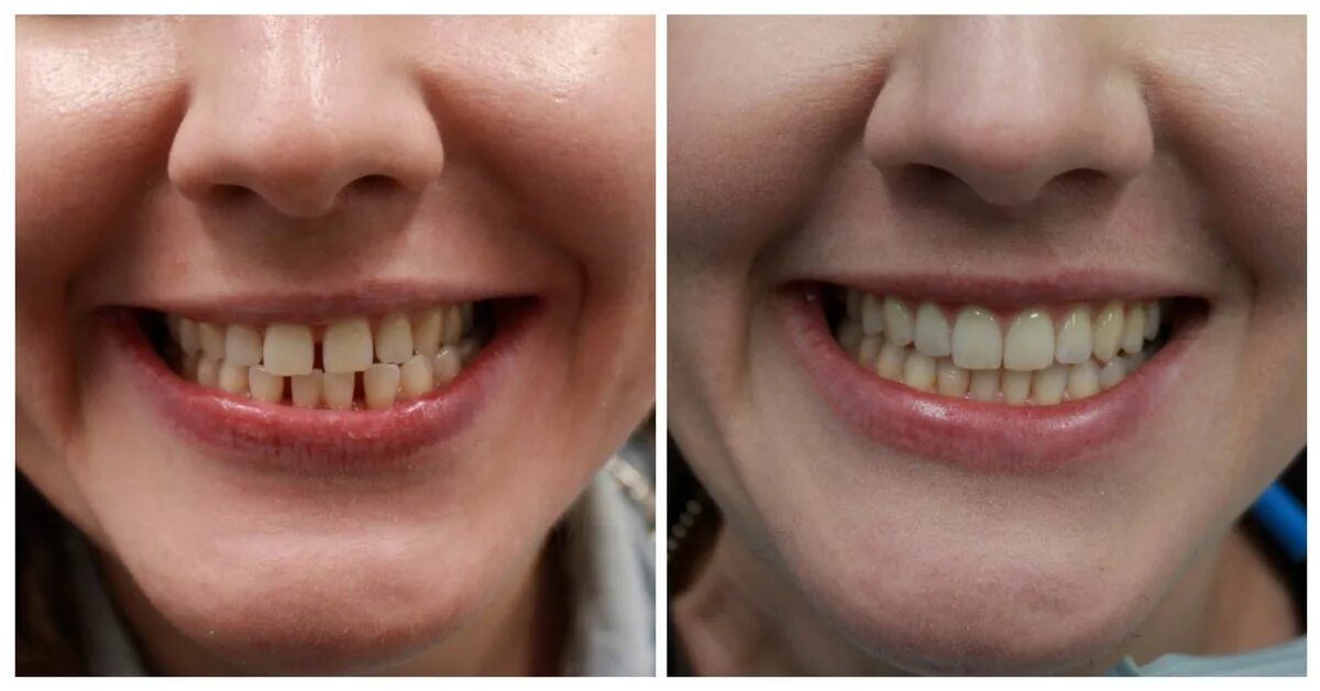 Правильные зубы фото Invisalign Cost NYC Save over $1400 with Our Invisalign Deals