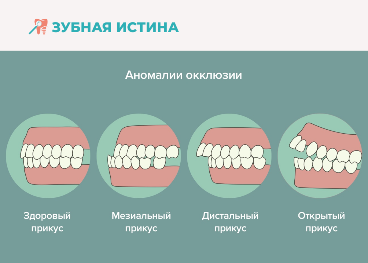 Правильный прикус зубов фото Какие проблемы может вызвать неправильный прикус? Зубная истина Дзен