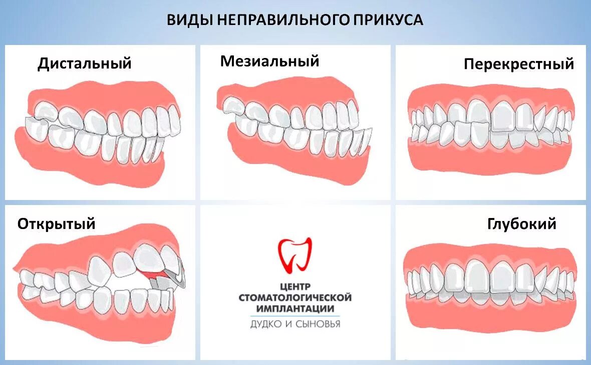 Правильный прикус зубов у человека фото Ortodoncja w Mińsku niski koszt w klinice Dudko i synowie