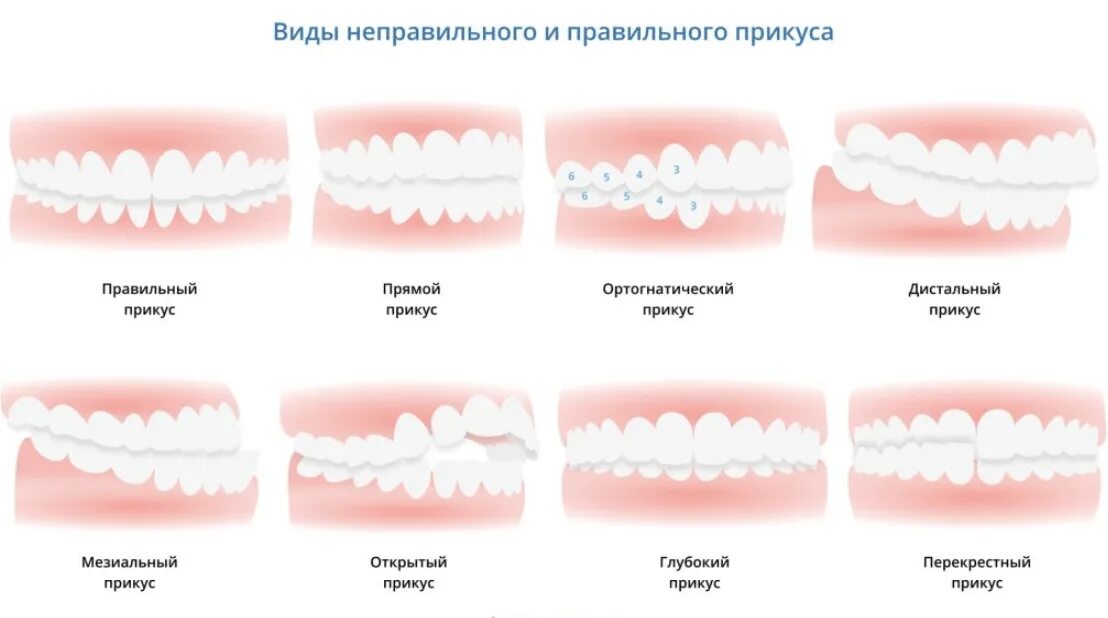 Правильный прикус зубов у человека фото Исправление прикуса у детей, взрослых в Минске, операция по исправлению прикуса,