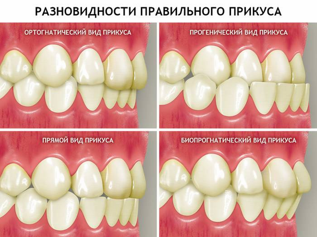 Правильный прикус зубов у человека фото Исправление прикуса