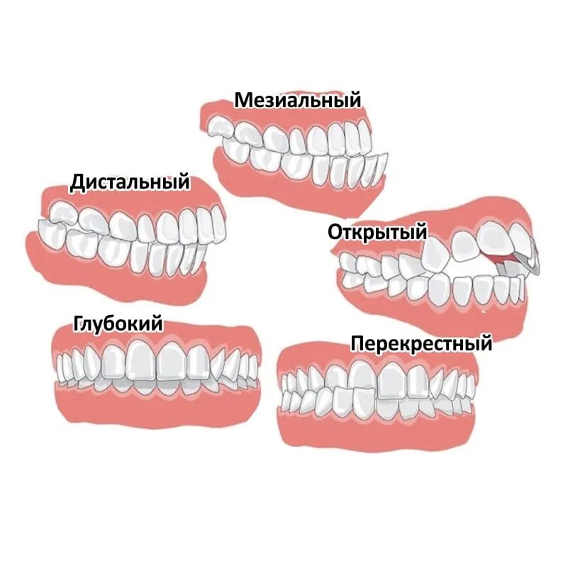 Неправильный прикус у ребенка: как определить