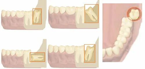 Правильный зуб мудрости фото Зачем нам "восьмерки"? Назначение зубов мудрости Стоматология Королевская улыбка