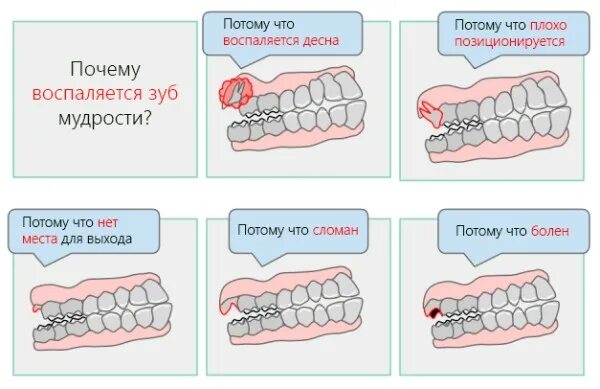 Правильный зуб мудрости фото Удаление зуба мудрости - цена в Москве, рекомендации после удаления - "Дентал Ар