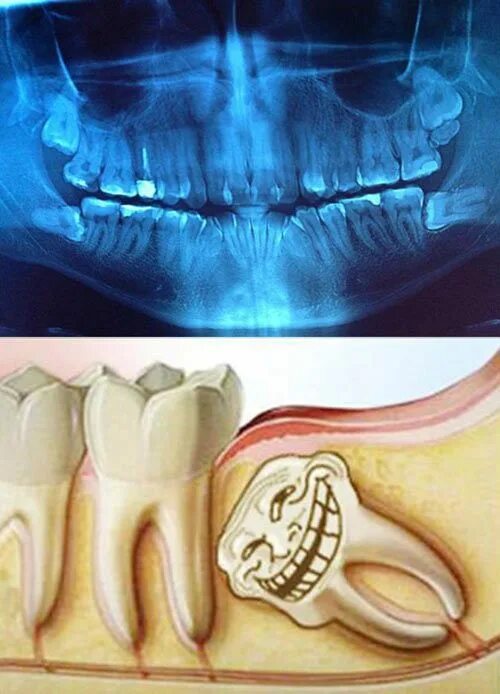 Правильный зуб мудрости фото The Internet's Most Asked Questions Wisdom teeth, Laser teeth whitening, Teeth w