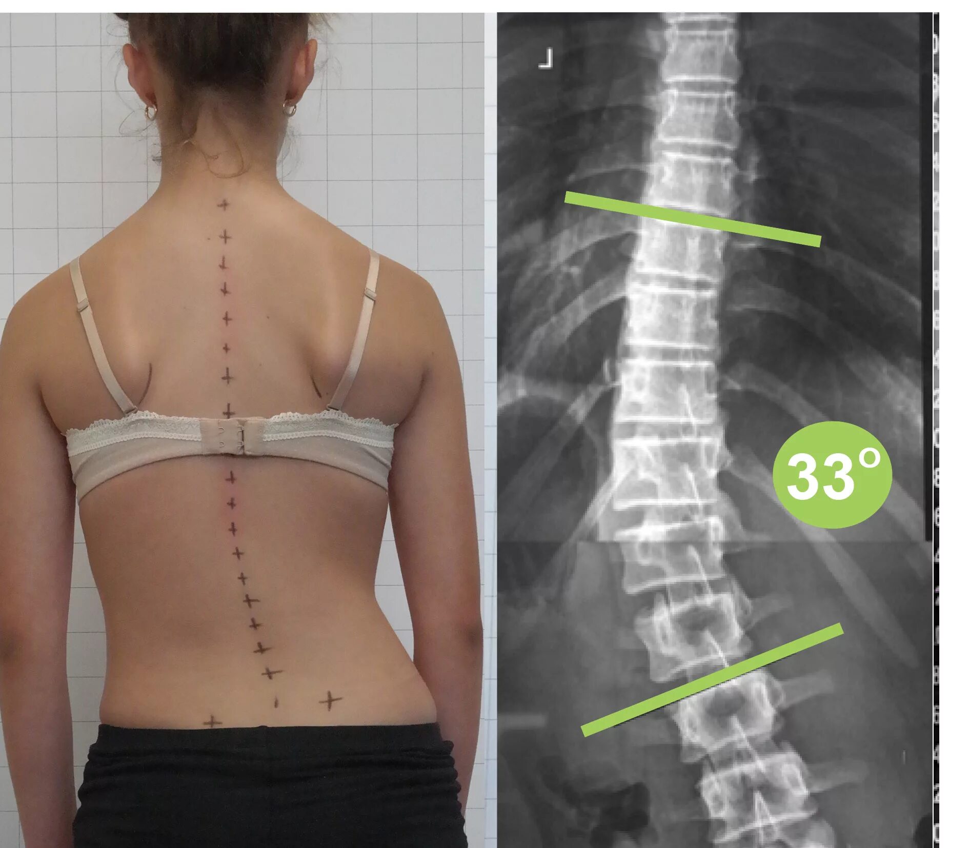 Правосторонний сколиоз грудного отдела фото A scoliosis Journey - Week 3 - Scoliosis Clinic UK - Treating Scoliosis without 