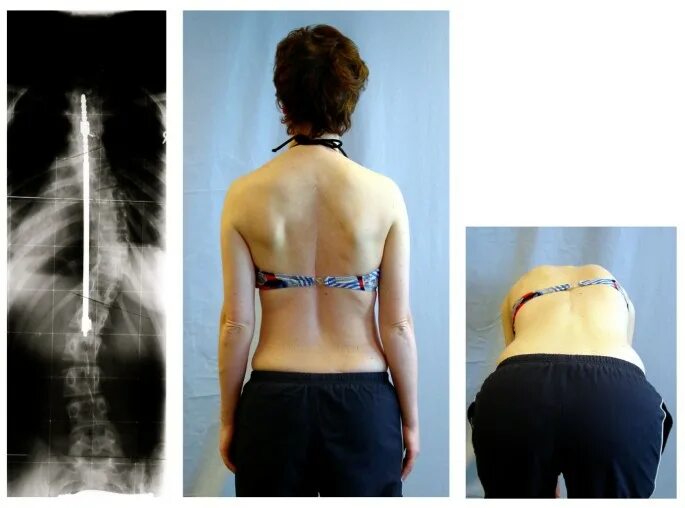 Правосторонний сколиоз грудного отдела фото Rate of complications in scoliosis surgery - a systematic review of the Pub Med 