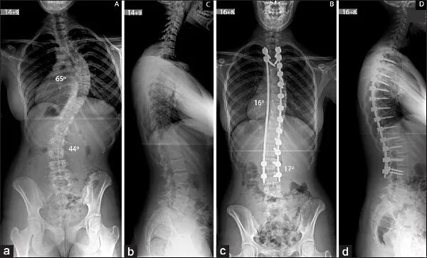 Правосторонний сколиоз грудного отдела фото Правосторонний сколиоз грудного отдела позвоночника. Упражнения при правосторонн