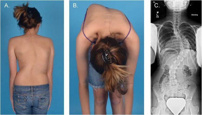 Правосторонний сколиоз грудного отдела фото Боль у мужчин в области поясницы лечение, причины, симптомы, защемление нерва кл