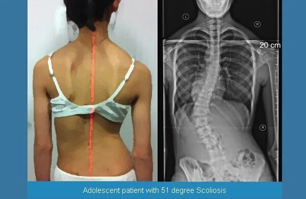 Правосторонний сколиоз грудного отдела фото scoliosis - Chiropractic BioPhysics