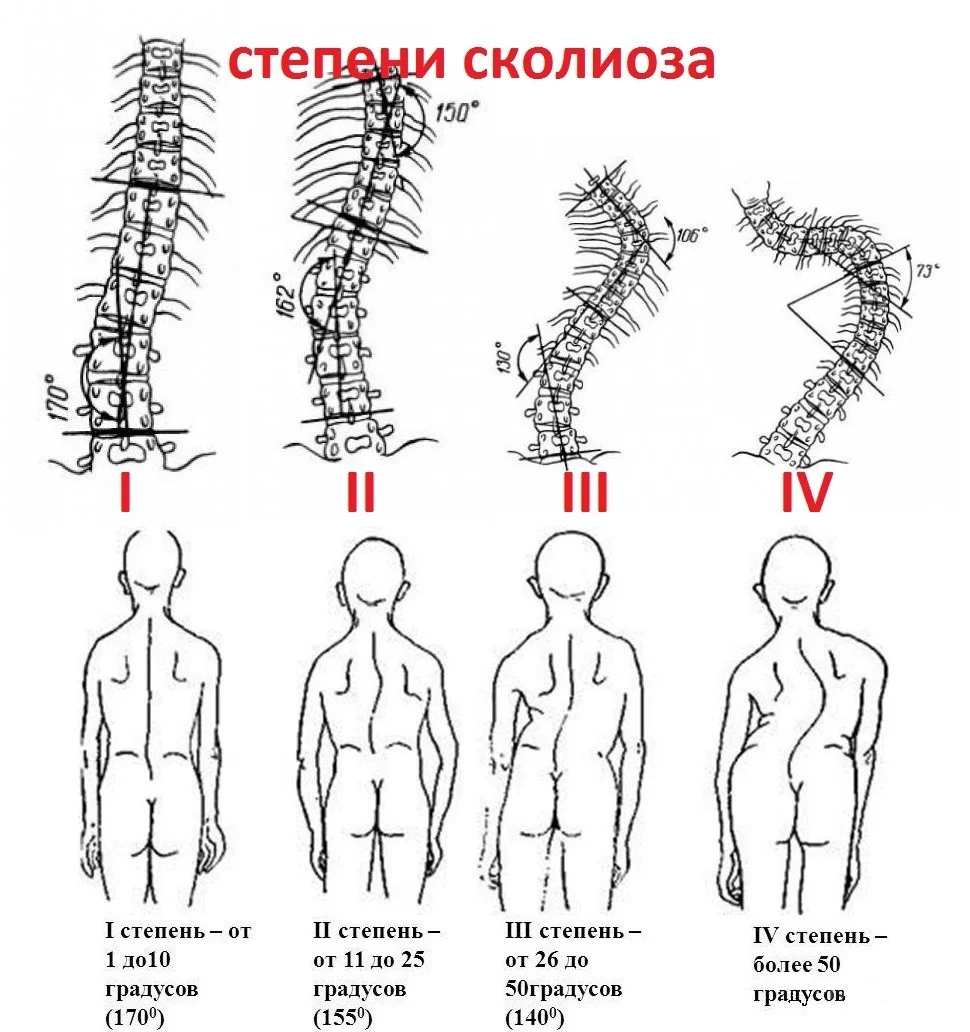 Правосторонний сколиоз грудного отдела позвоночника фото Берут ли в армию со сколиозом? Сколиоз и армия