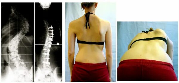 Правосторонний сколиоз грудного отдела позвоночника фото Файл:Result after scoliosis surgery of severe scoliosis.jpg - Википедия