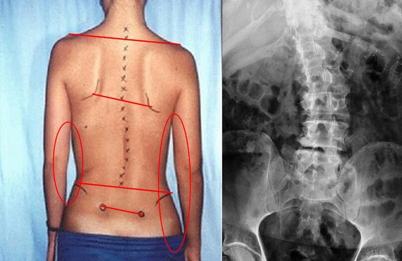 Правосторонний сколиоз грудного отдела позвоночника фото Сколиоз поясничного отдела позвоночника Движение без боли Дзен
