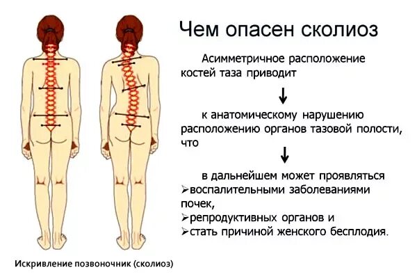 Правосторонний сколиоз грудного отдела позвоночника фото ЛФК при грудном сколиозе: виды, примеры комплексов упражнений