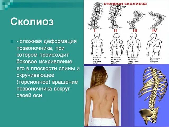 Правосторонний сколиоз грудного отдела позвоночника фото Как называется стойкое боковое искривление позвоночника