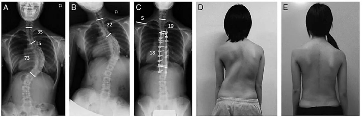 Правосторонний сколиоз грудного отдела позвоночника фото Операция при сколиозе Пикабу