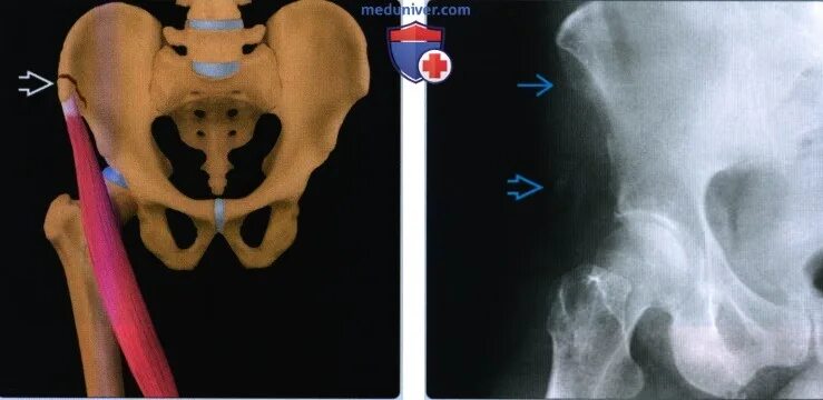 Правой подвздошной кости фото Признаки отрывного перелома таза и/или апофизита