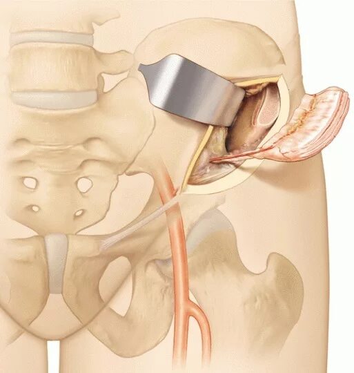 Правой подвздошной кости фото Что такое Лоскут гребня подвздошной кости (DCIA flap) NEOPLASTY