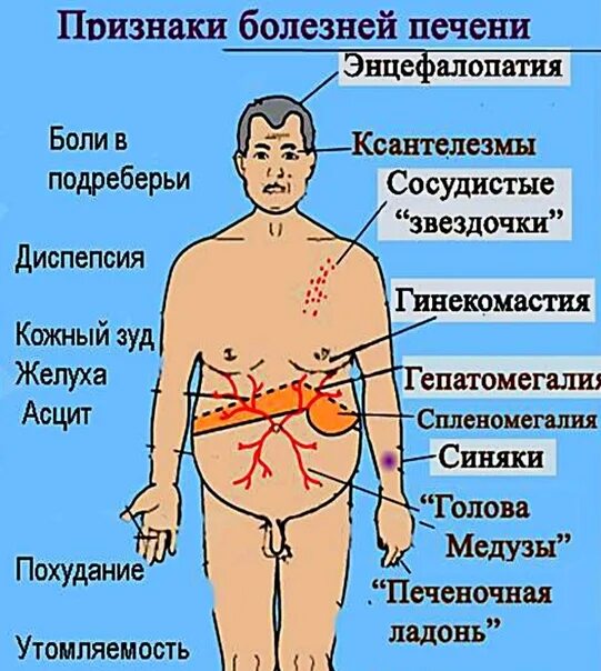 При болезнях печени на теле болезни фото Картинки ЦИРРОЗ ПРИЗНАКИ У МУЖЧИН ПЕРВЫЕ СИМПТОМЫ