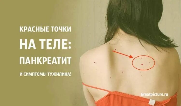 При болезнях печени на теле болезни фото Красные точки на теле: Панкреатит и симптом Тужилина in 2024 Herbal medicine, Me