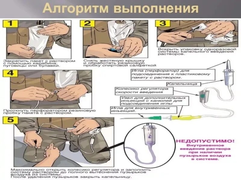 При подключении инфузионной системы к пвк необходимо Вену для ставления капельницы выбирают на основании ряда факторов и условий Межд