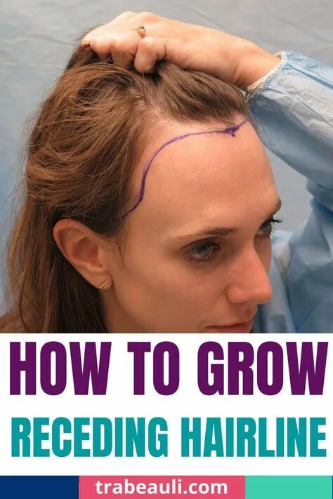 Прическа лоб фото 10 ide dan inspirasi how to grow receding hair line terbaik