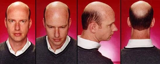 Прическа лысеющего мужчины фото Male Pattern Baldness Hereditary - FREE PATTERNS