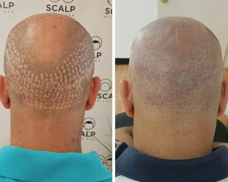 Прическа озеро в лесу мужская фото Hair Transplant on (con imágenes) Cejas