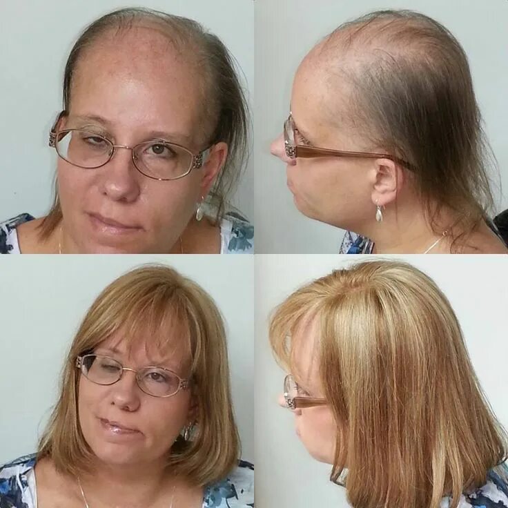 Прическа при алопеции для женщин Wigs For Frontal Hair Loss https://www.hairlossmenwomen.com/wigs-for-frontal-hai