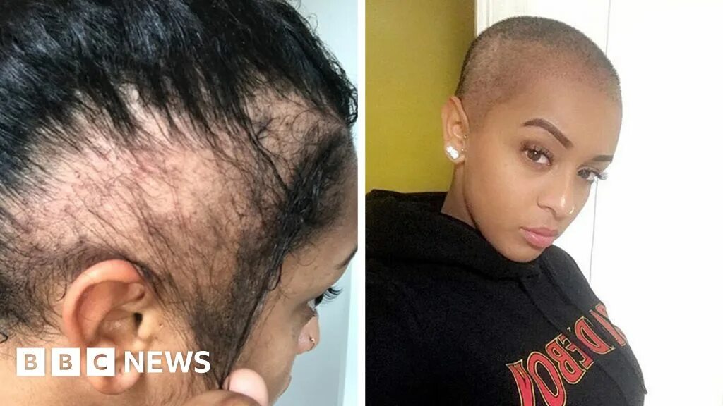 Прическа при алопеции для женщин I had a transplant after my hairstyle made me go bald - BBC News