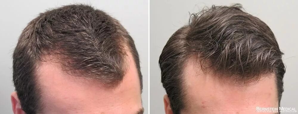 Прически для роста волос Finasteride results after 1 year reddit