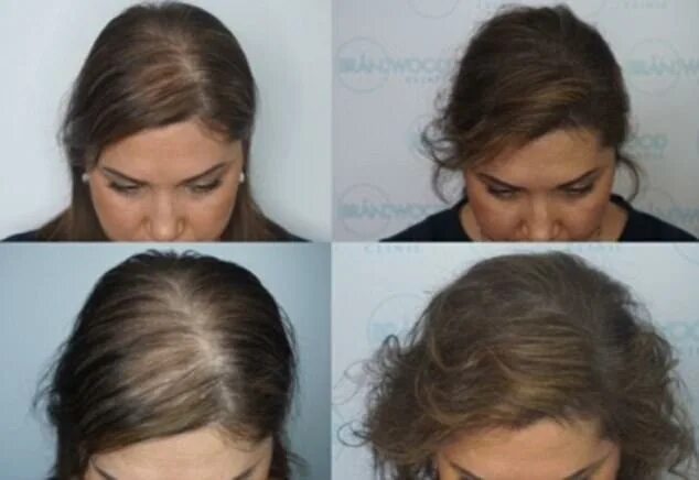 Прически когда мало волос Balding woman gets confidence back thanks to hair tattoo Daily Mail Online